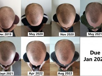 hair regrowth before and after derma roller scalp massage pumpkin seed oil finasteride
