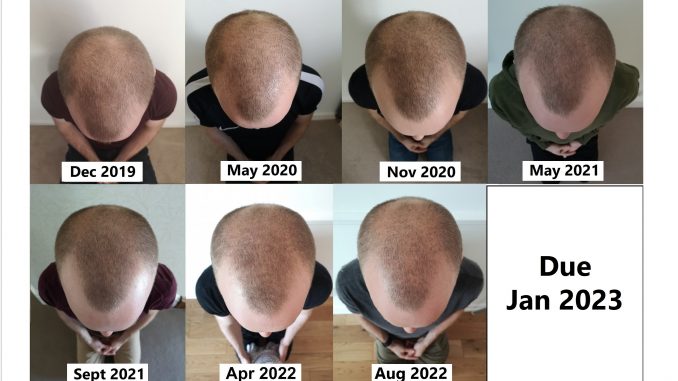 hair regrowth before and after derma roller scalp massage pumpkin seed oil finasteride