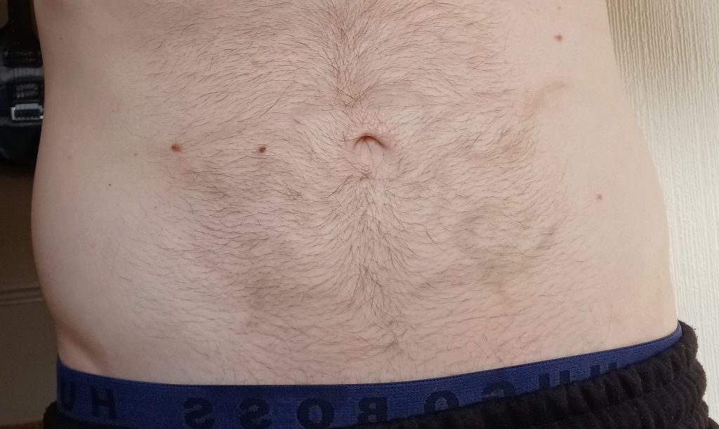 Laser Tattoo Removal - Before and After
