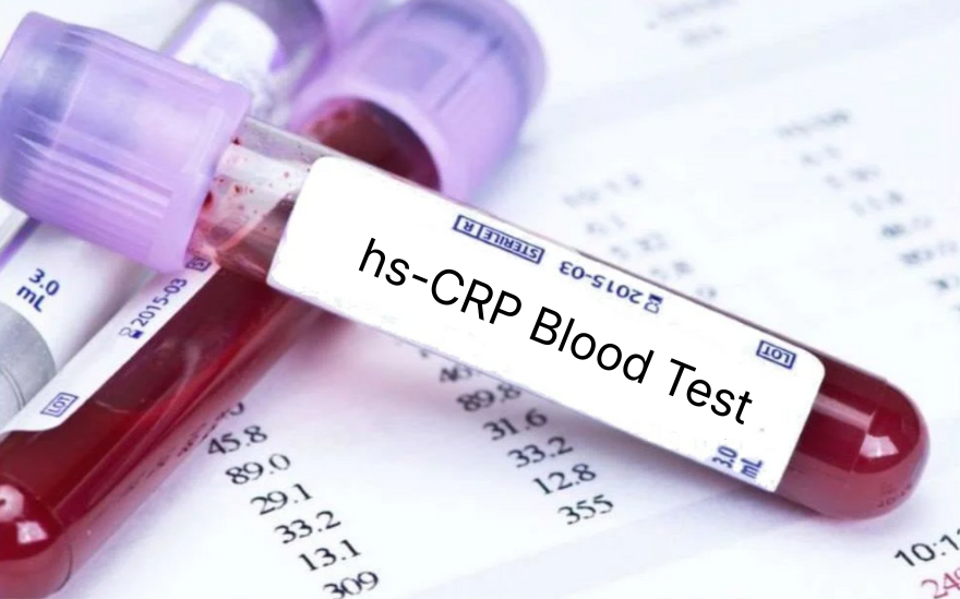 How To Measure Inflammation With A CRP Blood Test